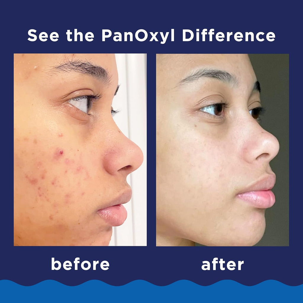 PanOxyl Foaming Acne Wash 10% Benzoyl Peroxide