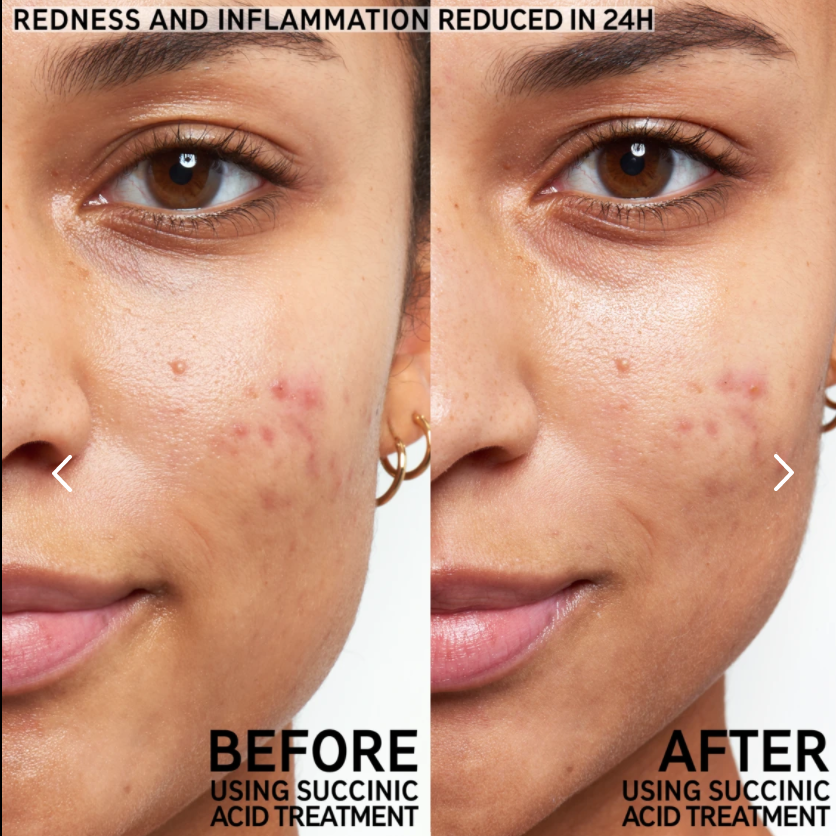 The INKEY List Succinic Acid Blemish Treatment - Glamorous Beauty