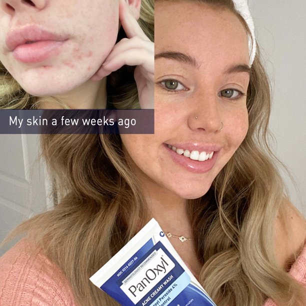 PanOxyl Creamy Acne Wash, Daily Control, 4% Benzoyl Peroxide